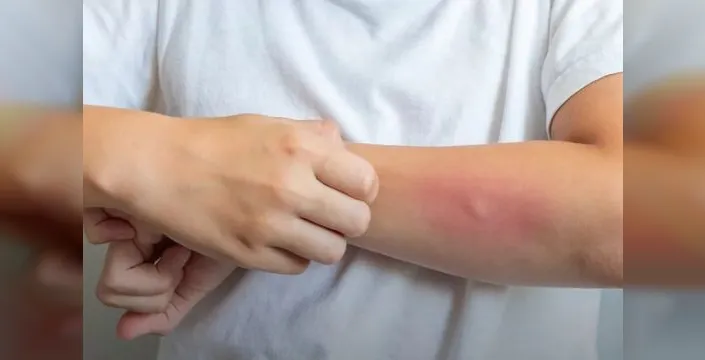 Egzama, sosyal yaşamı da olumsuz etkileyebiliyor