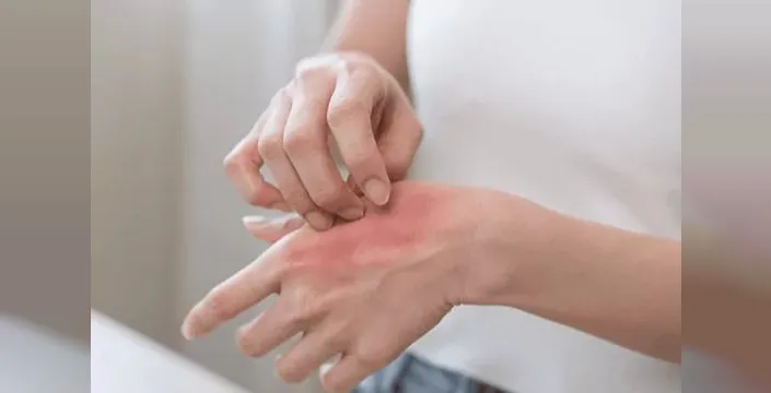 Kaşıntı sadece cilt sorunu değil, stresle de ilgili